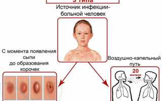 Ветрянка. Причины, симптомы и признаки, диагностика и лечение болезни у детей