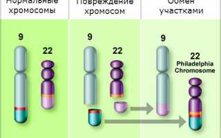 Хронический миелолейкоз — причины, симптомы, диагностика, лечение и прогноз для пациентов