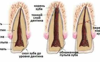 Пример из судебной практики – перелом коронки и корня зуба