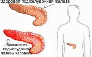 Острый панкреатит — причины, симптомы, современная диагностика, лечение, диета после панкреатита, осложнения болезни и рекомендации по восстановлению