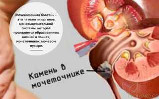 Камни мочеточника (уретеролитиаз) — причины, симптомы, диагностика и лечение уретеролитиаза у пациентов.