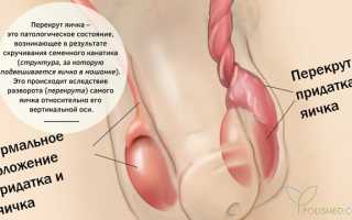 Перекрут яичка. Причины, симптомы, диагностика и лечение патологии у мужчин