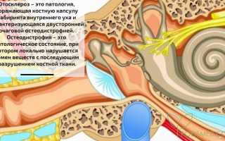 Отосклероз. Причины, симптомы, диагностика, профилактика и лечение патологии у пациентов