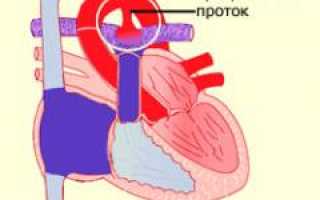 Открытый артериальный проток: причины и лечение