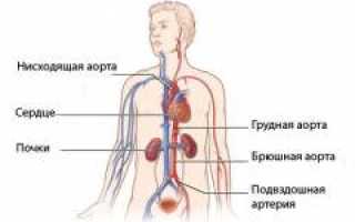Аневризма брюшной аорты. Причины, симптомы, признаки, диагностика и лечение патологии у пациентов