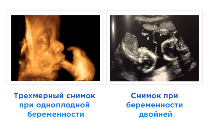 УЗИ на 35 неделе