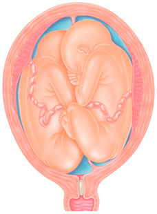 Двойня на 39 неделе