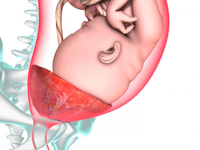 предлежание плаценты