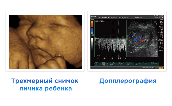 Узи на 39 неделе