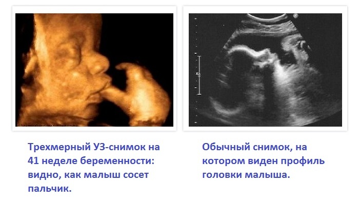 Обычный и трехмерный УЗ-снимок на 41 неделе беременности
