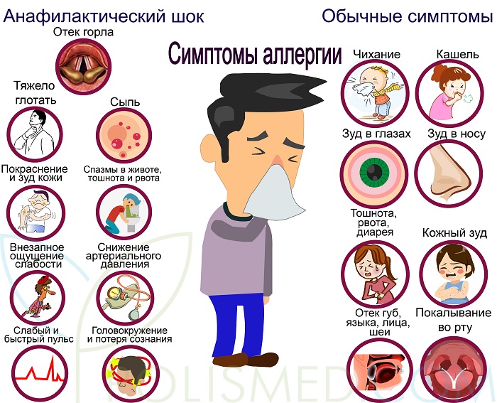 Симптомы аллергии