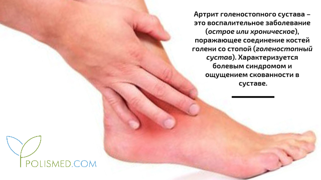 Артрит голеностопного сустава