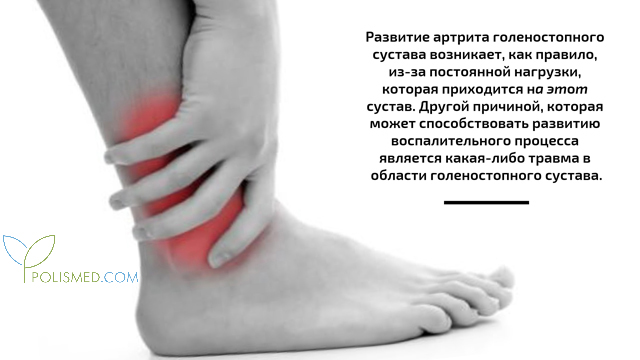 Виды артрита голеностопного сустава