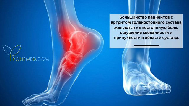 Признаки артрита голеностопного сустава