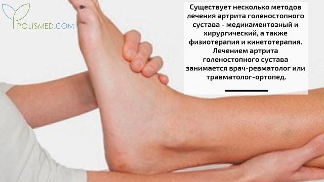 Лечение артрита голеностопного сустава