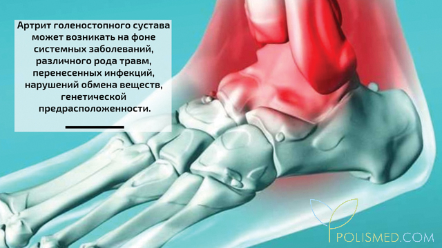 Причины артрита голеностопного сустава