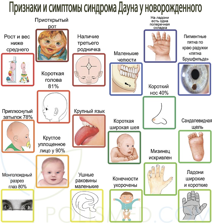 симптомы синдрома у новорожденного