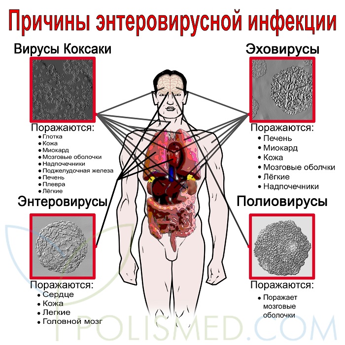 Причины энтеровируса