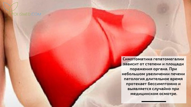 Симптомы гепатомегалии
