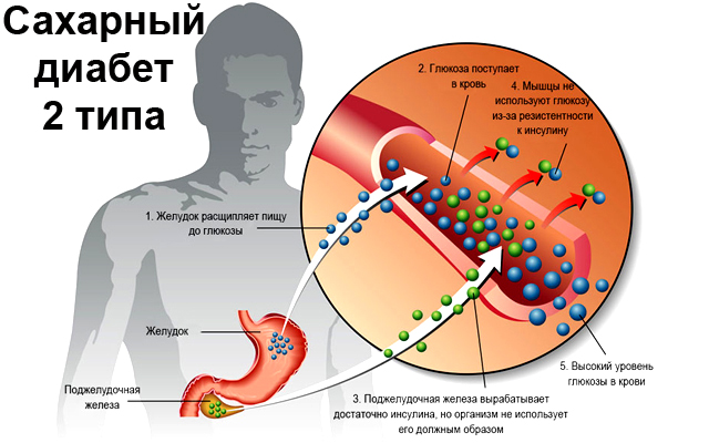Диабет 2-го типа