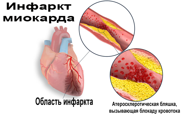 Инфаркт миокарда