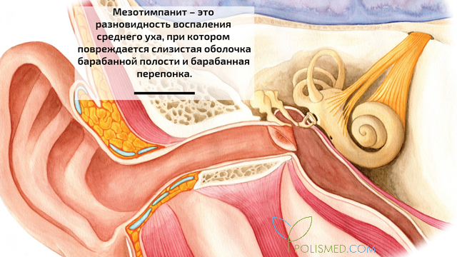 Мезотимпанит