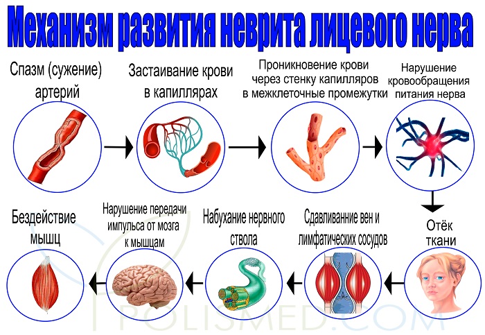 Механизм развития неврита