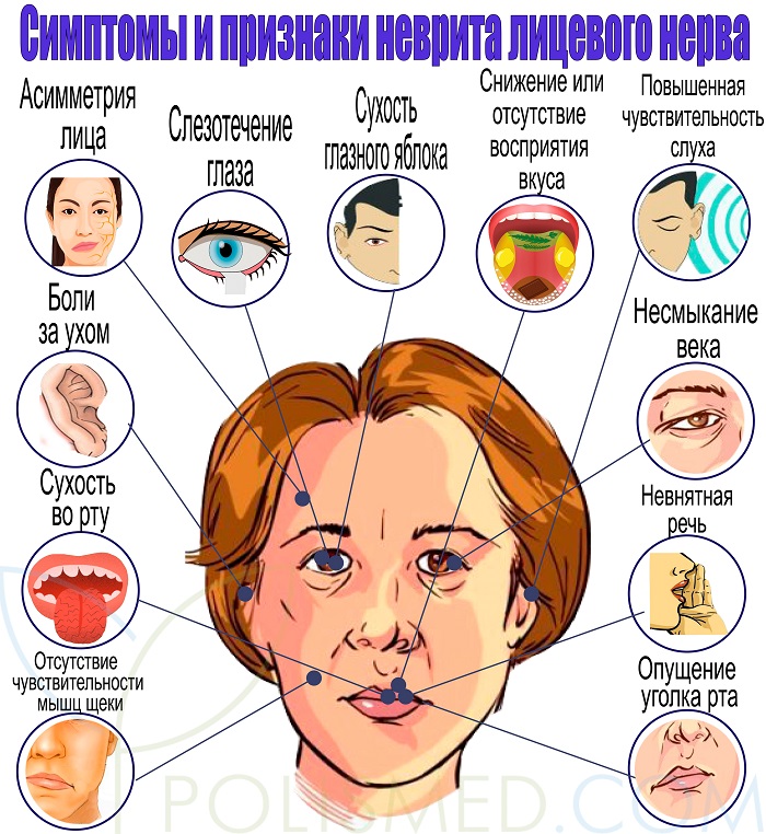 симптомы неврита