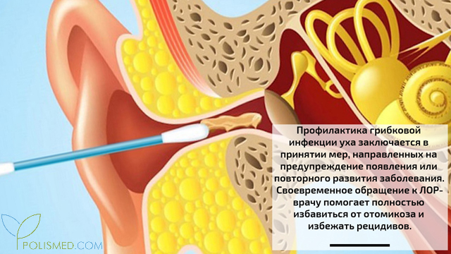 Профилактика отомикоза
