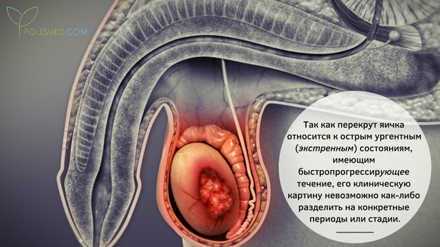 Формы и стадии перекрута яичка