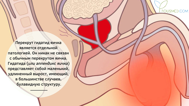 Отличие перекрута гидатид яичка от перекрута яичка