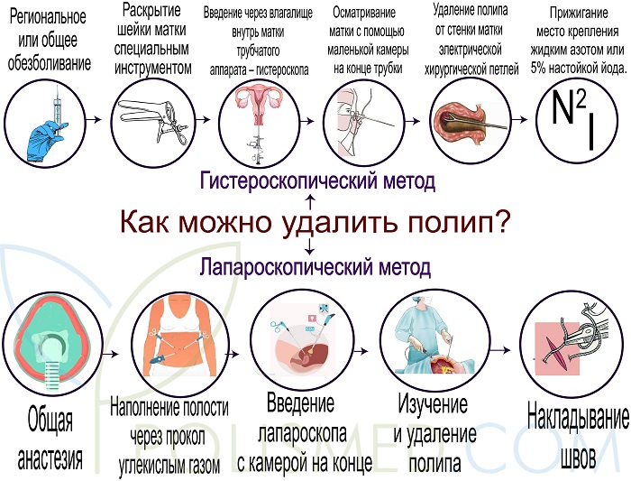 Удаление полипов матки