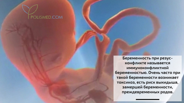 Беременность при резус-конфликте