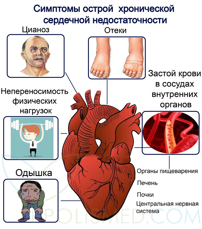 Симптомы хронической сердечной недостаточности