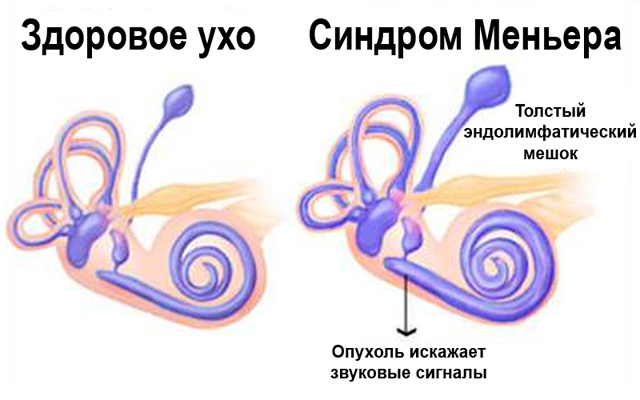 Синдром Меньера