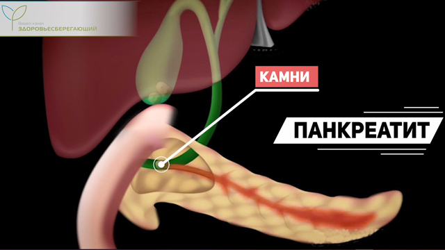Панкреатит