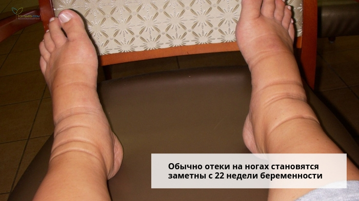Отеки на ногах