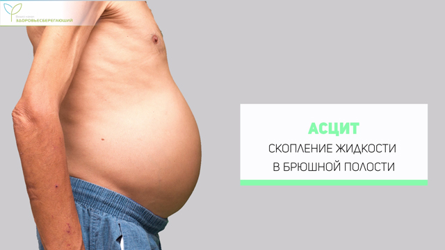 Асцит