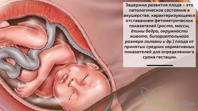 Задержка развития плода
