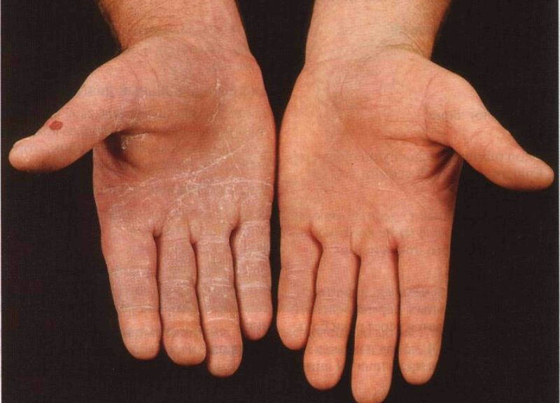 Грибок на ладонях