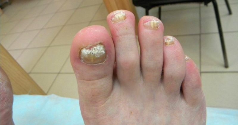 Грибок ногтях ног