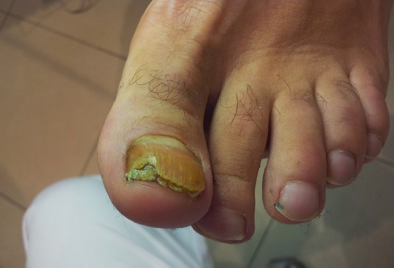 Грибок на пальцах ног