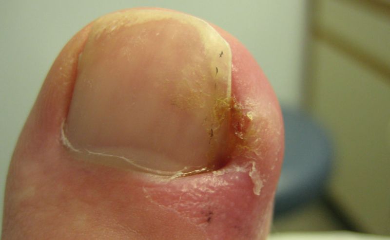 Нарыв на пальце ноги