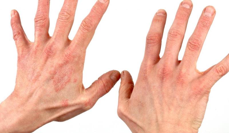 Нейродермит на руках