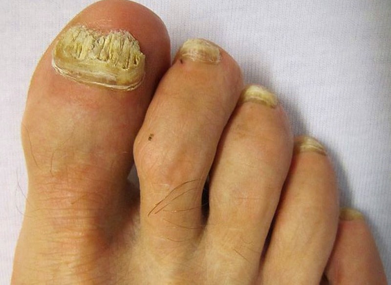 Онихомикоз