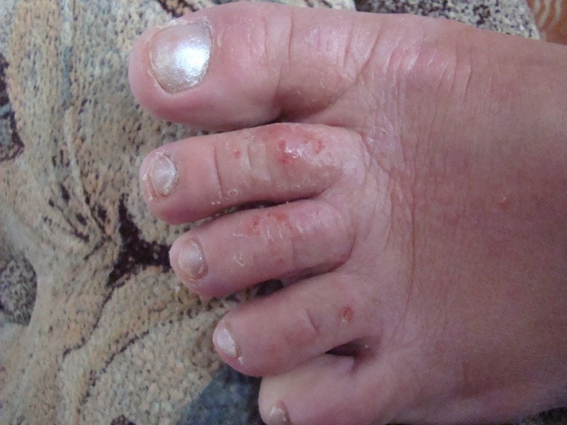 Опрелость на пальцах ног