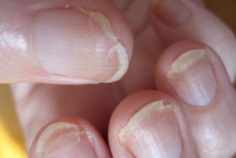 Отслоение ногтевой пластины