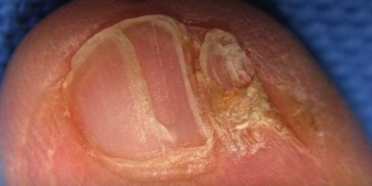 Отслоение ногтя