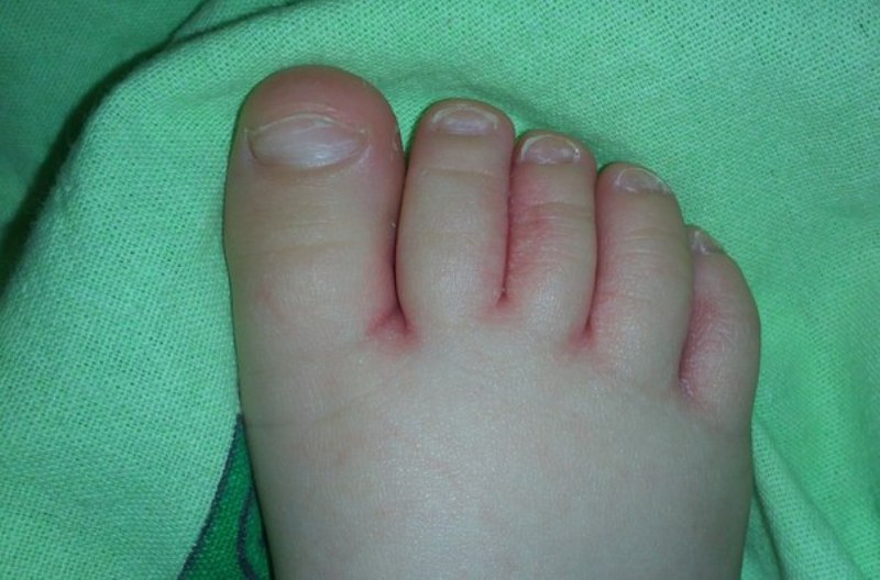 Покраснение между пальцами ног у ребенка