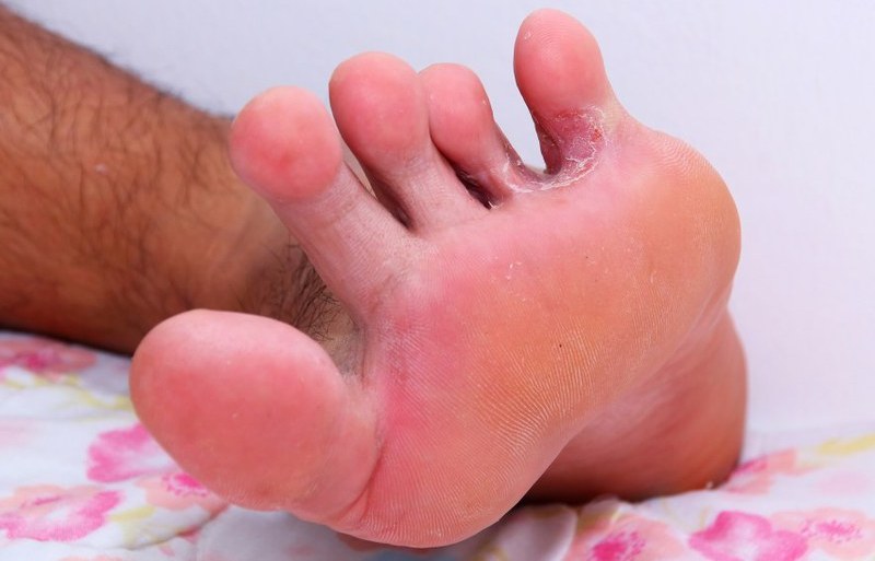 Грибок между пальцами ног